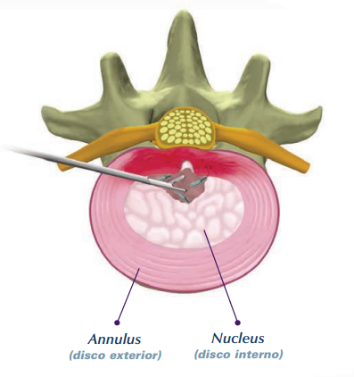 DISC-FX – Lumbar®