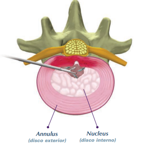 DISC-FX – Lumbar®